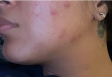 Load image into Gallery viewer, CLEAR SKIN KIT